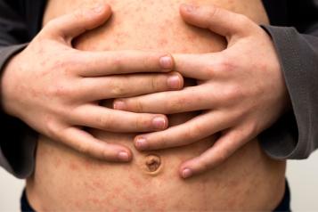 man with hands interlinked across his stomach. His skin is covered in a measles rash.