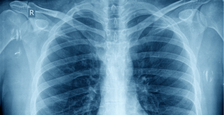 x-ray image of a chest