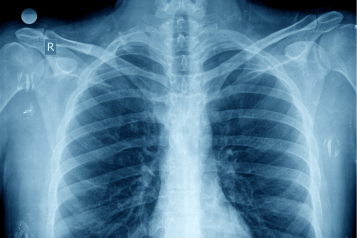 x-ray image of a chest